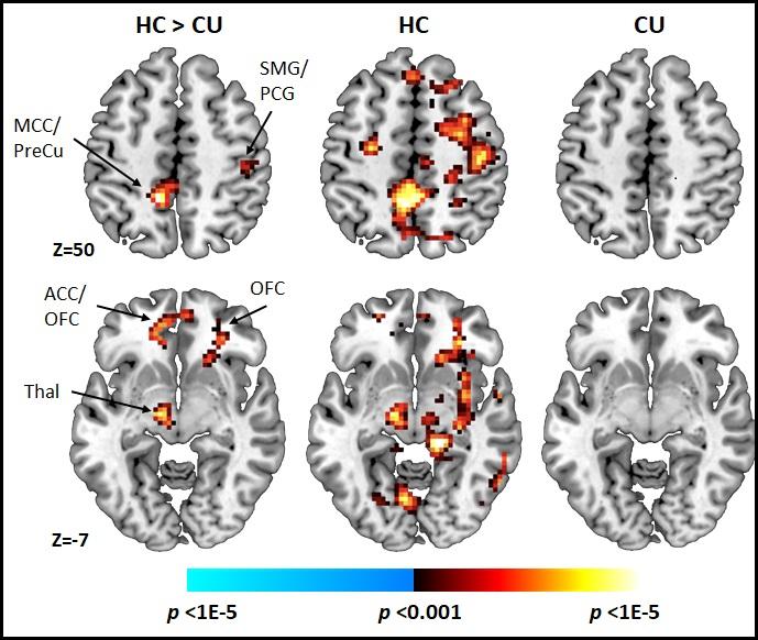 Ранната употреба на канабис води до драстични промени в когнитивните процеси на мозъка